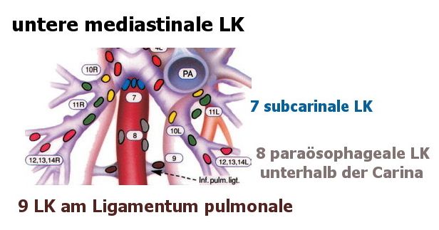 untere mediastinale LK