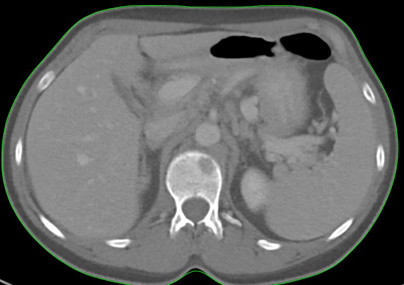 L1-Metastase