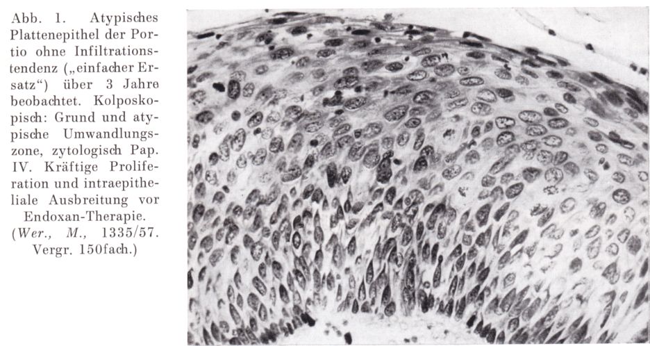 atypisches Epithel