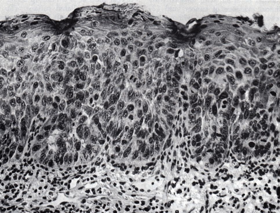 Carcinoma in situ