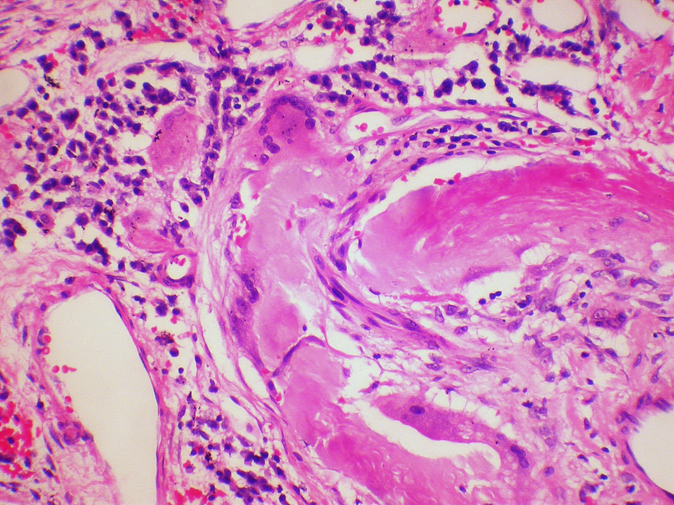 Amyloidose